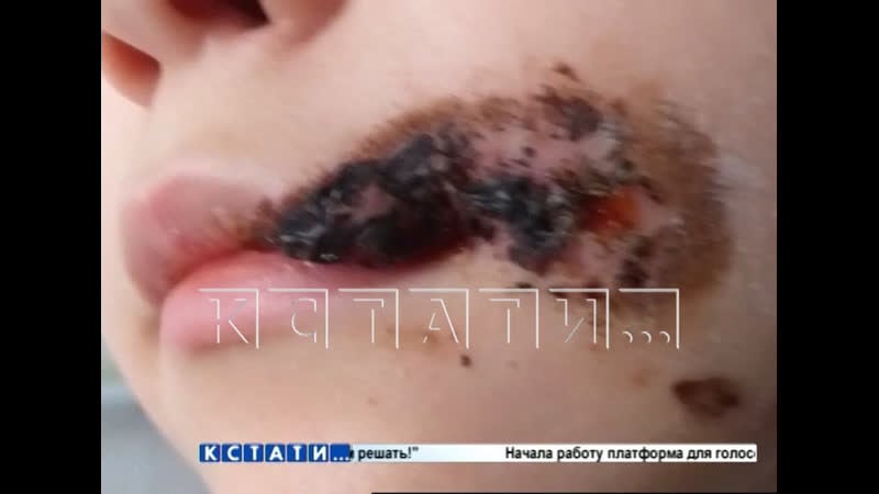 Бездомная молодые, которую прикормили жители, напала на ребенка и разорвала лицо