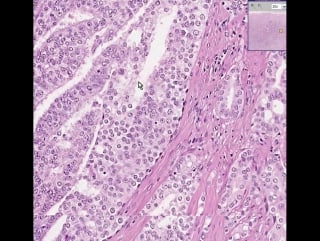 Prostate adenocarcinoma (gleason grade 4)