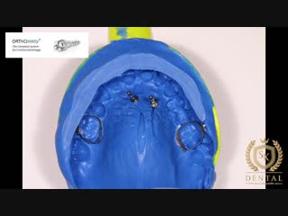 Tad anchored palatal expansion appliance by koval, msc ортодонтия