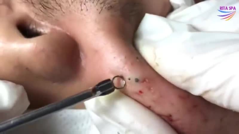 Черные точки и белые угри