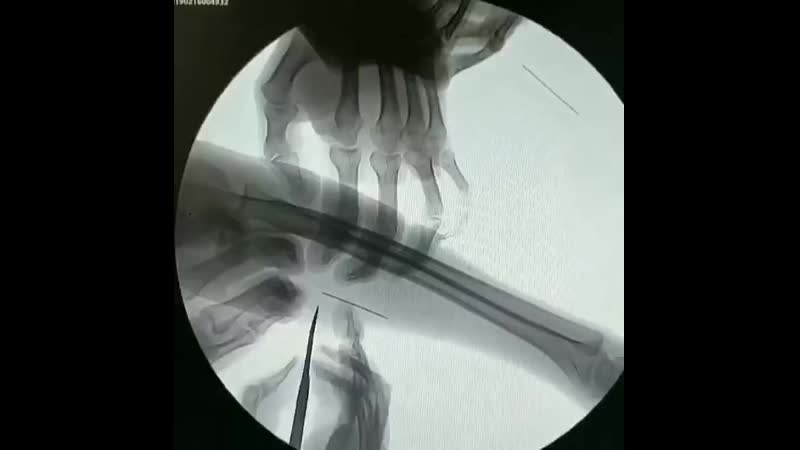 Достают иглы