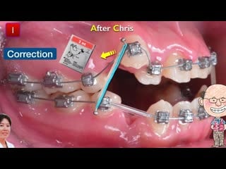 My perspective on digital orthodontics part 5 ортодонтия