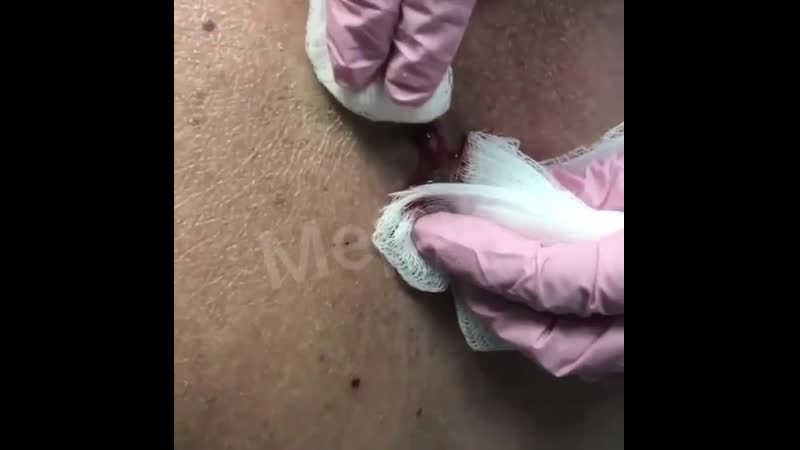 Абсцесс мерзостей вам в ленту