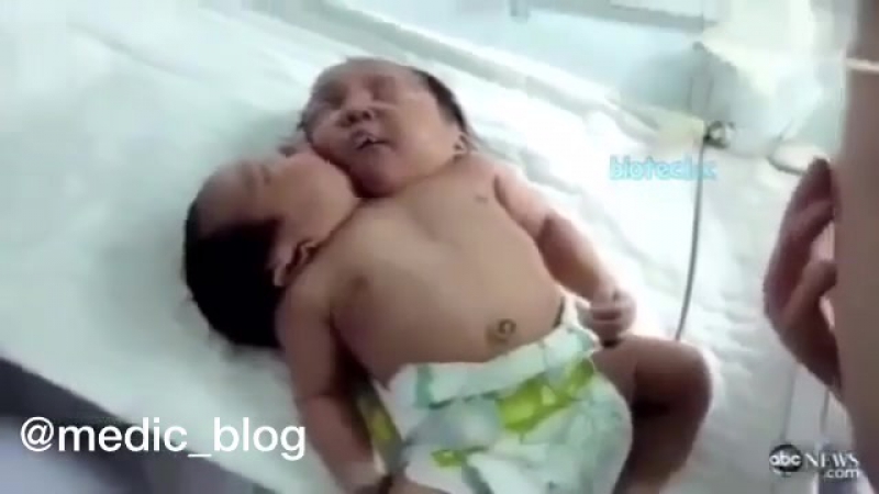 Такой вид сиамских близнецов крайне редок во всем мире