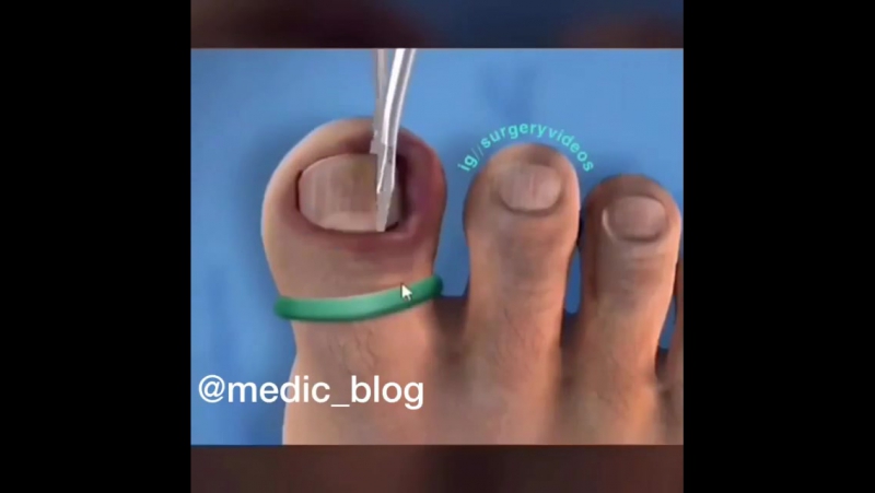 Удаление нагноения из под ногтя