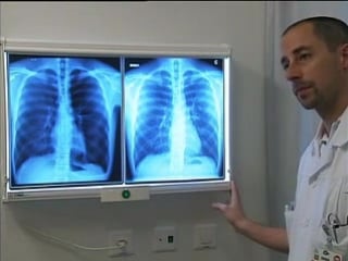 Needle aspiration of pneumothorax by the nejm