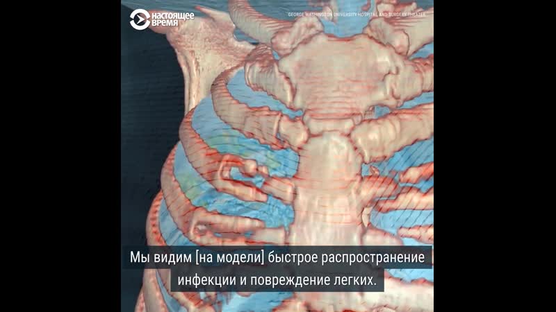 3d модель легких заразившегося вирусом человека