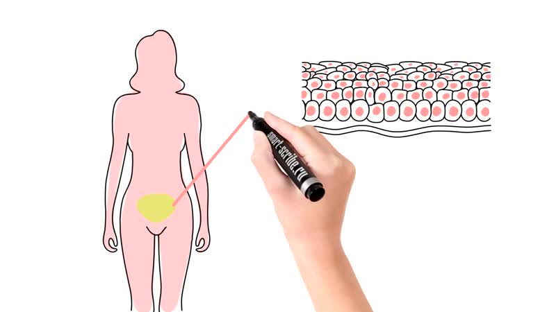 Современные представления о прогрессии интраэпителиальных неоплазий и новейшие возможности терапии