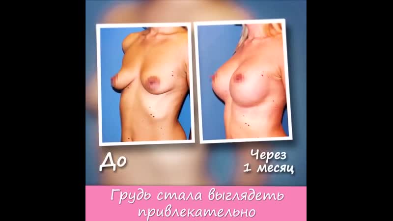 Эндопротезирование груди