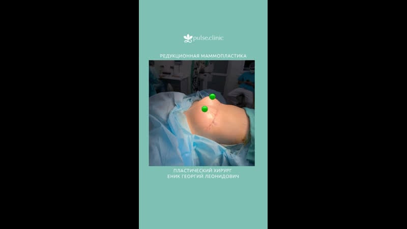 Редукционная маммопластика уменьшение груди в архангельске подтяжка груди в архангельске клиника пульс