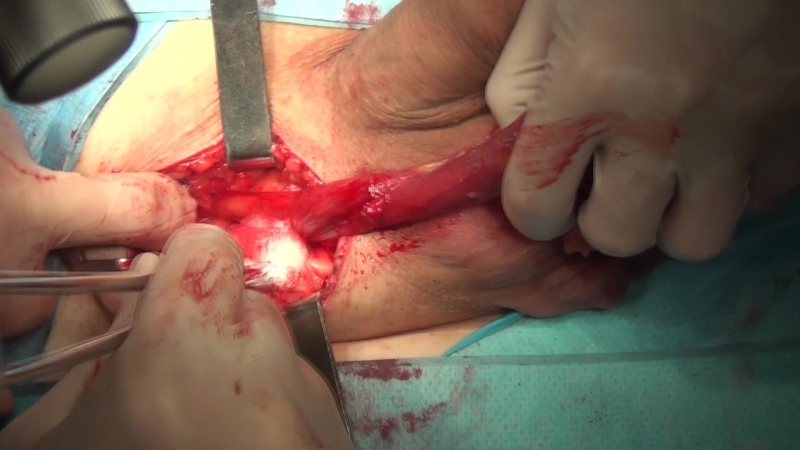 Орхофуникулэктомия (удаление опухоли яичка)