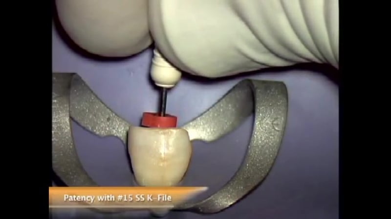 Procedural atlas of conventional endodontic therapy эндодонтия