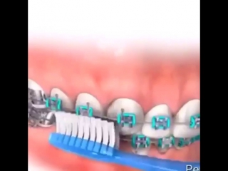 Как правильно чистить зубы с брекетами⁉️