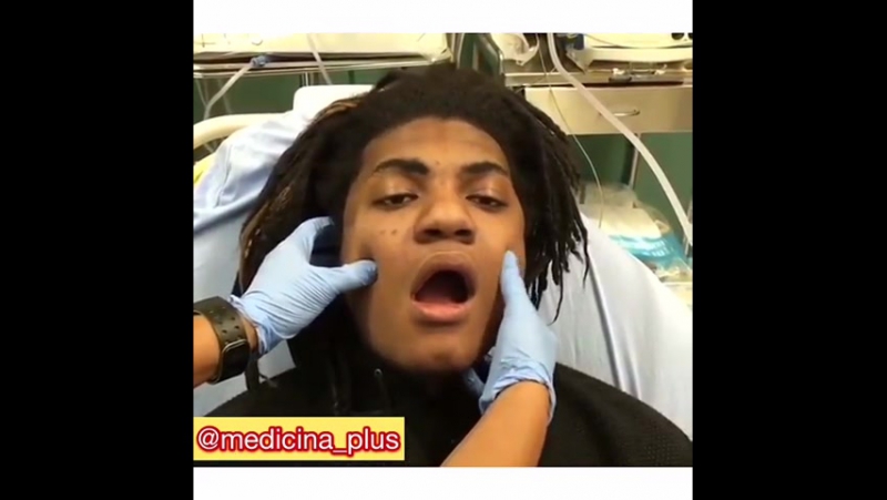 Вправление вывиха челюсти