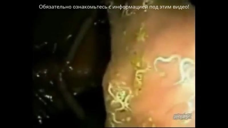 Глисты у человека (паразиты в организме) как избавиться от глистов