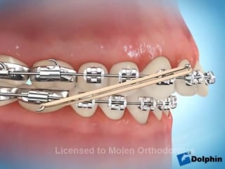 Overbite correction using rubber bands braces