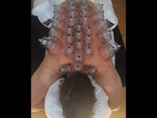 Chinese cupping therapy
