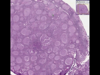 Lymph node follicular lymphoma, grade 2