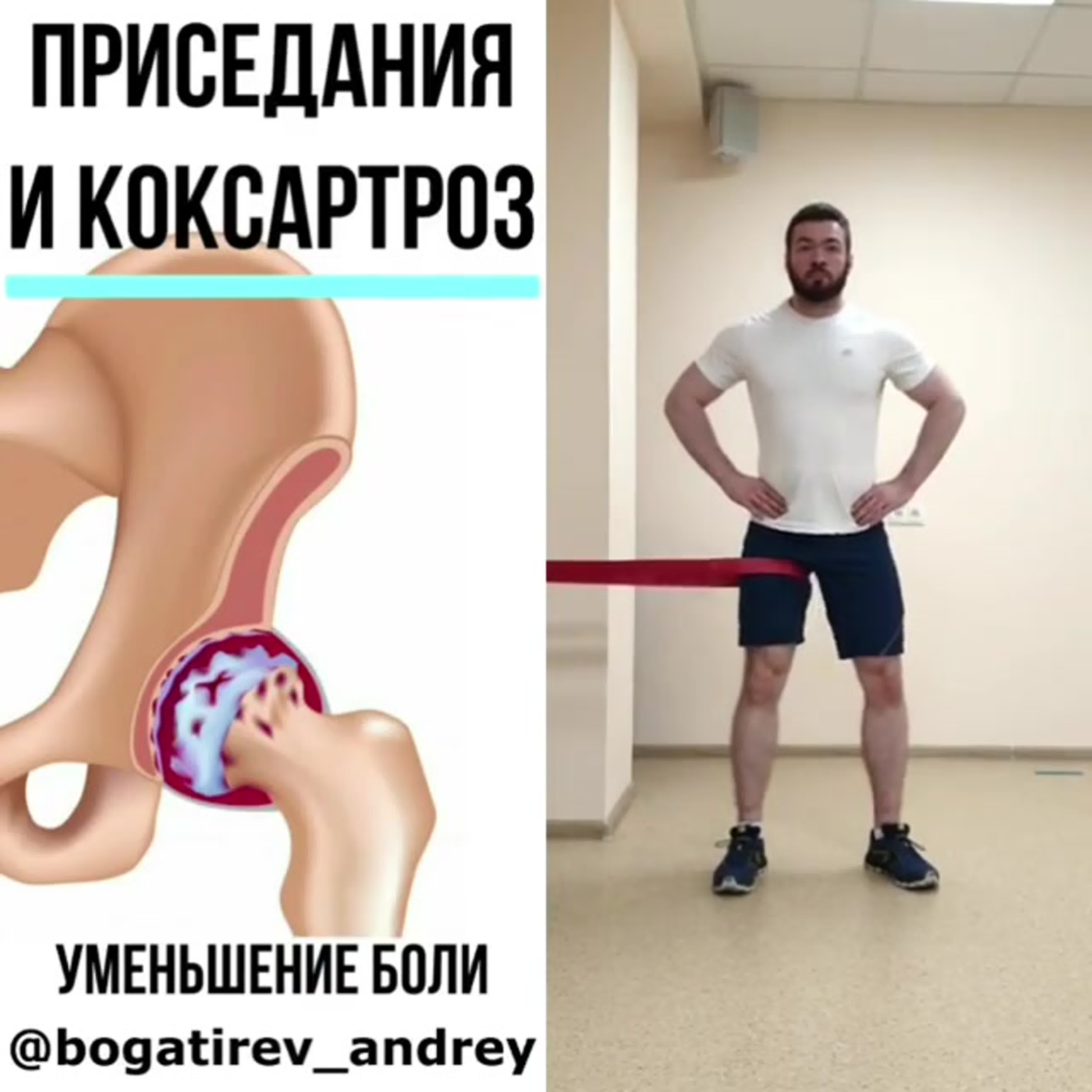 Приседания при коксартрозе