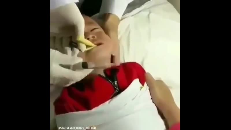 Извлечение инородного тела (монета) ❤️