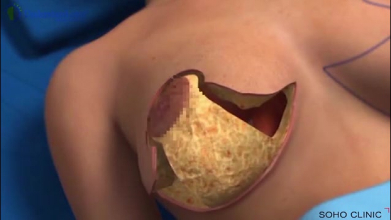 Можно ли кормить грудью после операции? что делает хирург, пока мы под наркозом? видео отвечает на все вопросы 😉 убеждаемся, ч