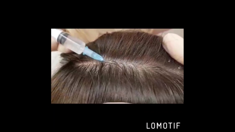 Мезотерапия