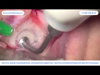 Ochistkazubov ru – чистка зубов аппаратом air flow в казани