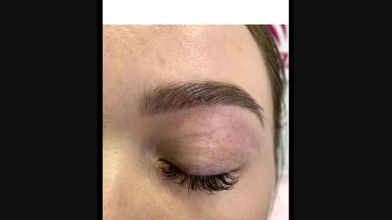 Безоперационная блефаропластика