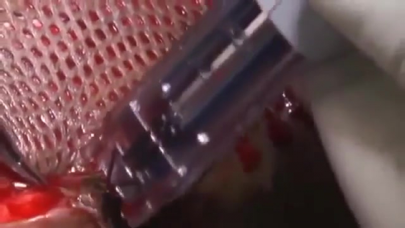 Пересадка кожи