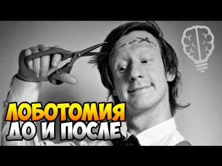 Что такое лоботомия 18+ [до и после] от канала тумблер