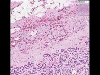 Prostate adenocarcinoma (gleason grade 3)