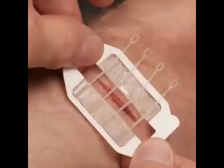 Zipstitch laceration kit surgical quality