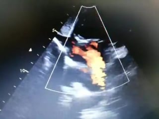 Ventricular septal defect atrial septal defect vsd asd echocardiograhy