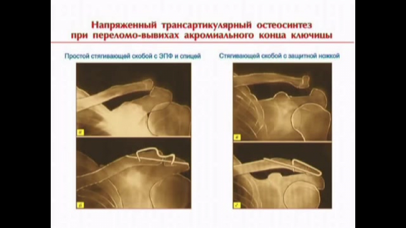 Остеосинтез с применением фиксаторов с памятью формы при переломах и несращениях ключицы