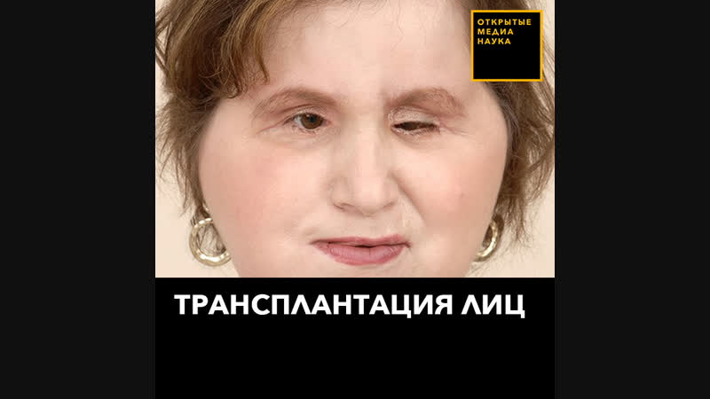 Трансплантация лиц
