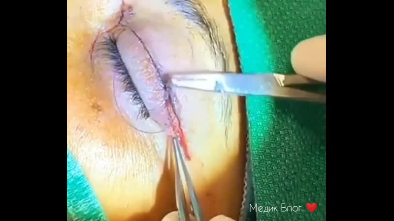 🎬 на видео процедура, под названием «блефаропластика»