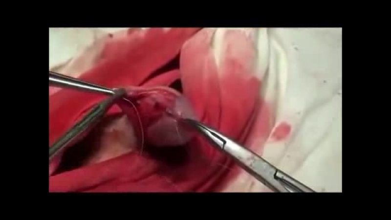 Хирургическое лечение фимоза