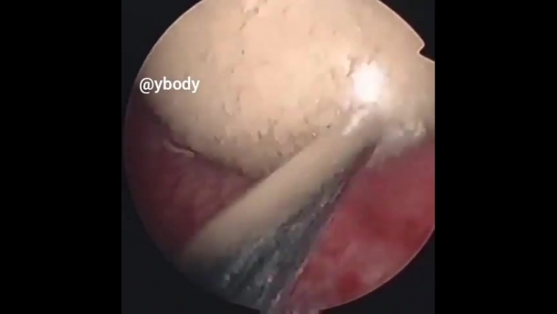 Дробление камня мочевого пузыря