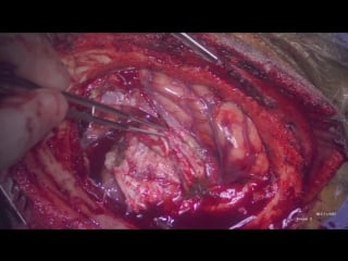 10 трепанация черепа, удаление атипичной менингиомы