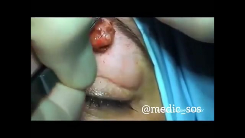 Удаление кисты верхнего века