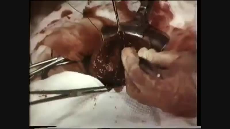 Корпоральное кесарево сечение