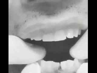 Перелом нижней челюсти