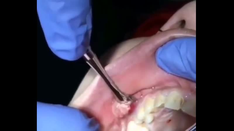 Поднадкостничный абсцесс (периостит) верхней челюсти