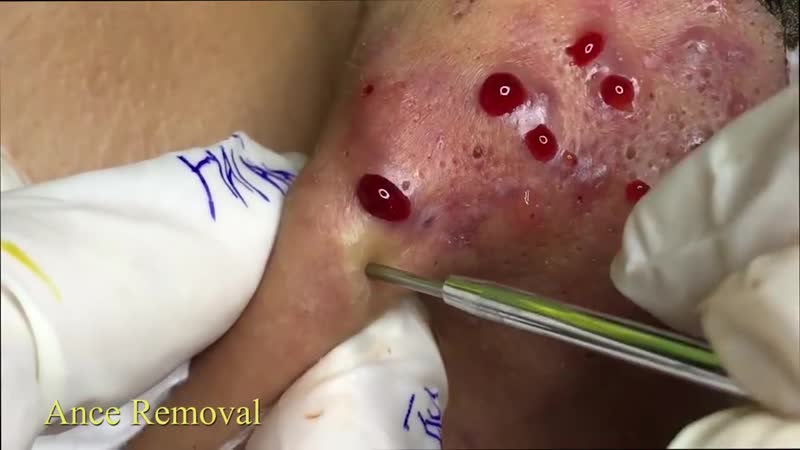 Воспаленные прыщи