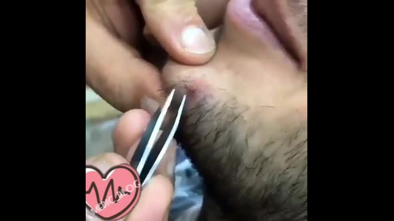 Удаление вросшего волоса