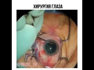Хирургия глаза