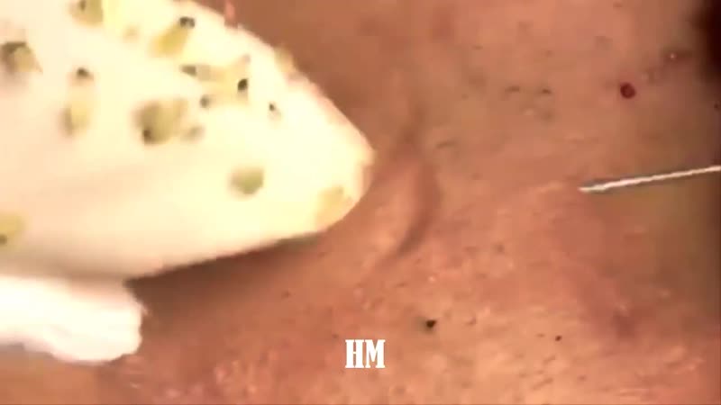 Большие и маленькие черные точки, угри, забитые поры