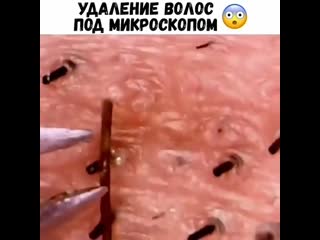Удаление волос под микроскопом