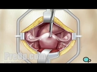 Гистерэктомия | hysterectomy