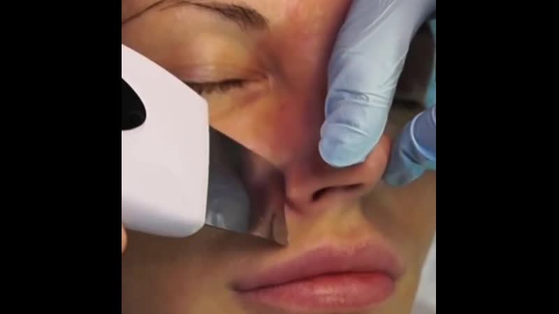 Ультразвуковая чистка лица в ялте